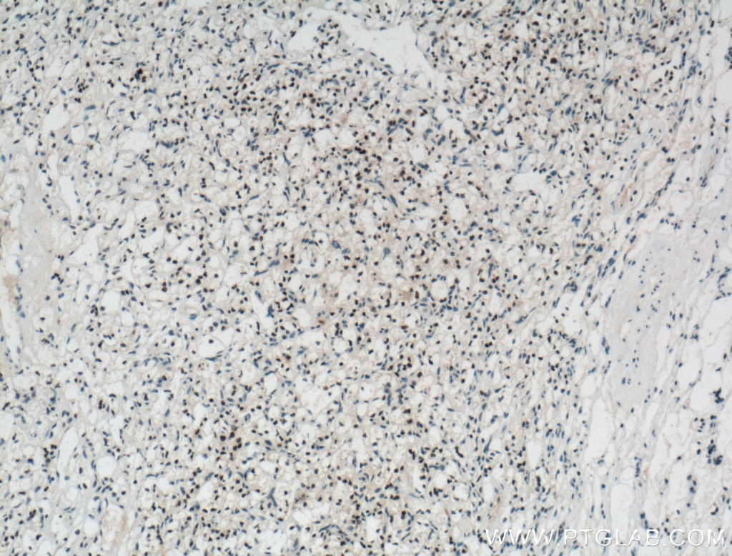 Immunohistochemistry (IHC) staining of human renal cell carcinoma tissue using Pan-PAX Polyclonal antibody (21383-1-AP)