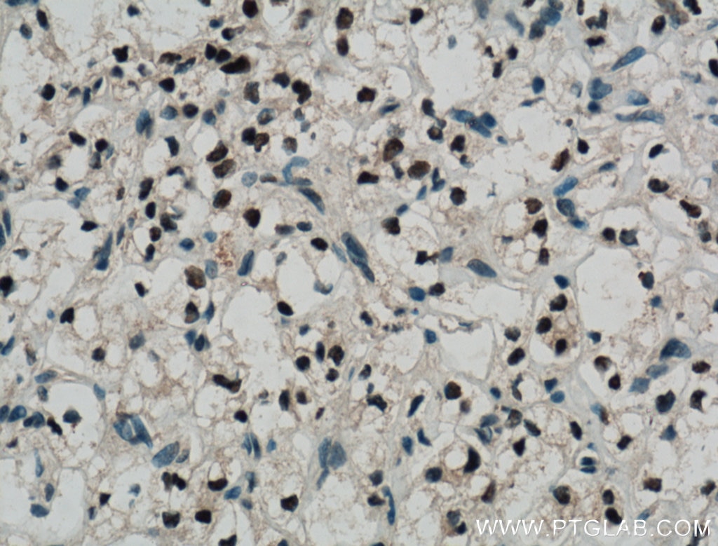 Immunohistochemistry (IHC) staining of human renal cell carcinoma tissue using Pan-PAX Polyclonal antibody (21383-1-AP)