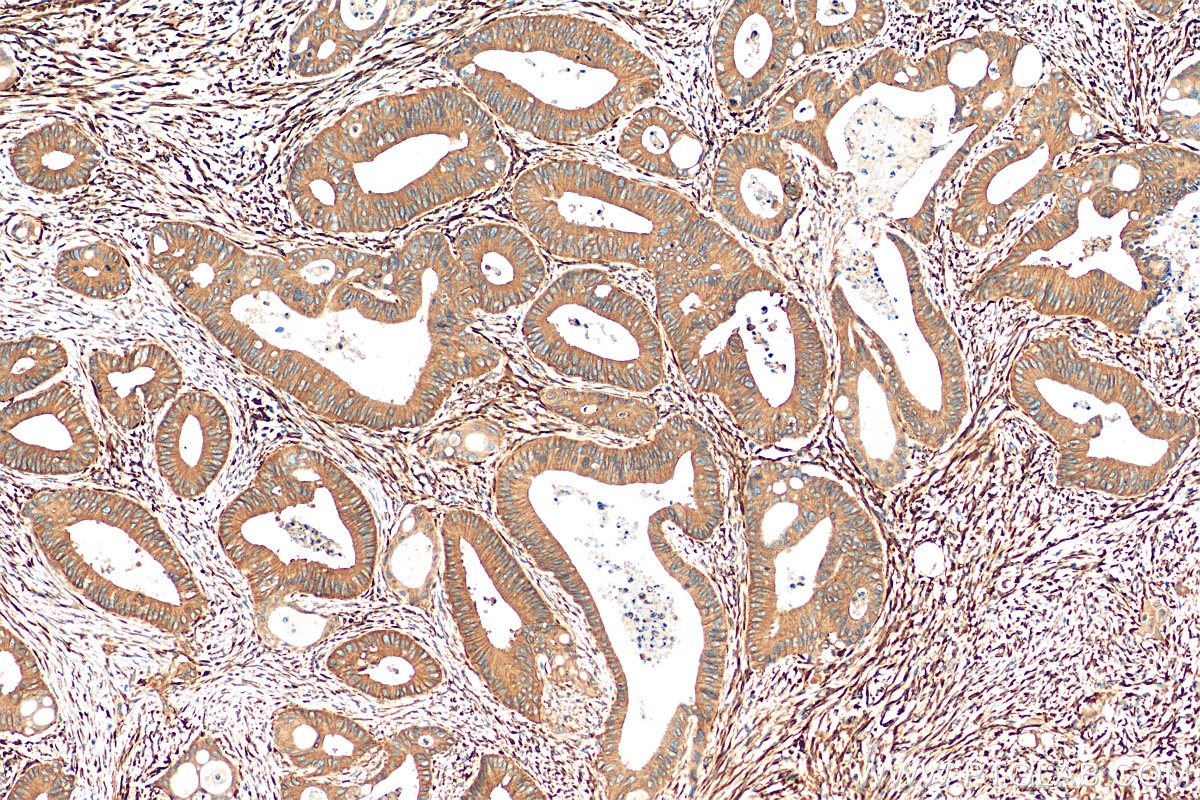 Immunohistochemistry (IHC) staining of human colon cancer tissue using pan-RAS Recombinant antibody (81615-1-RR)