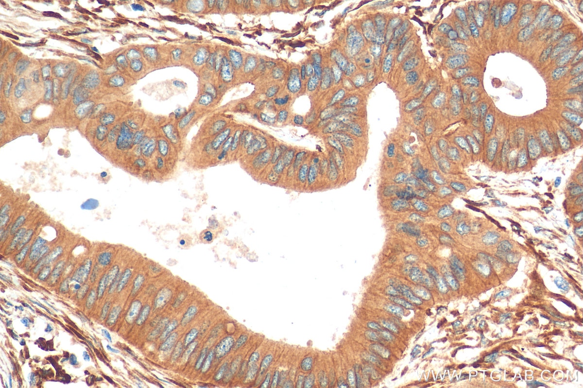 Immunohistochemistry (IHC) staining of human colon cancer tissue using pan-RAS Recombinant antibody (81615-1-RR)