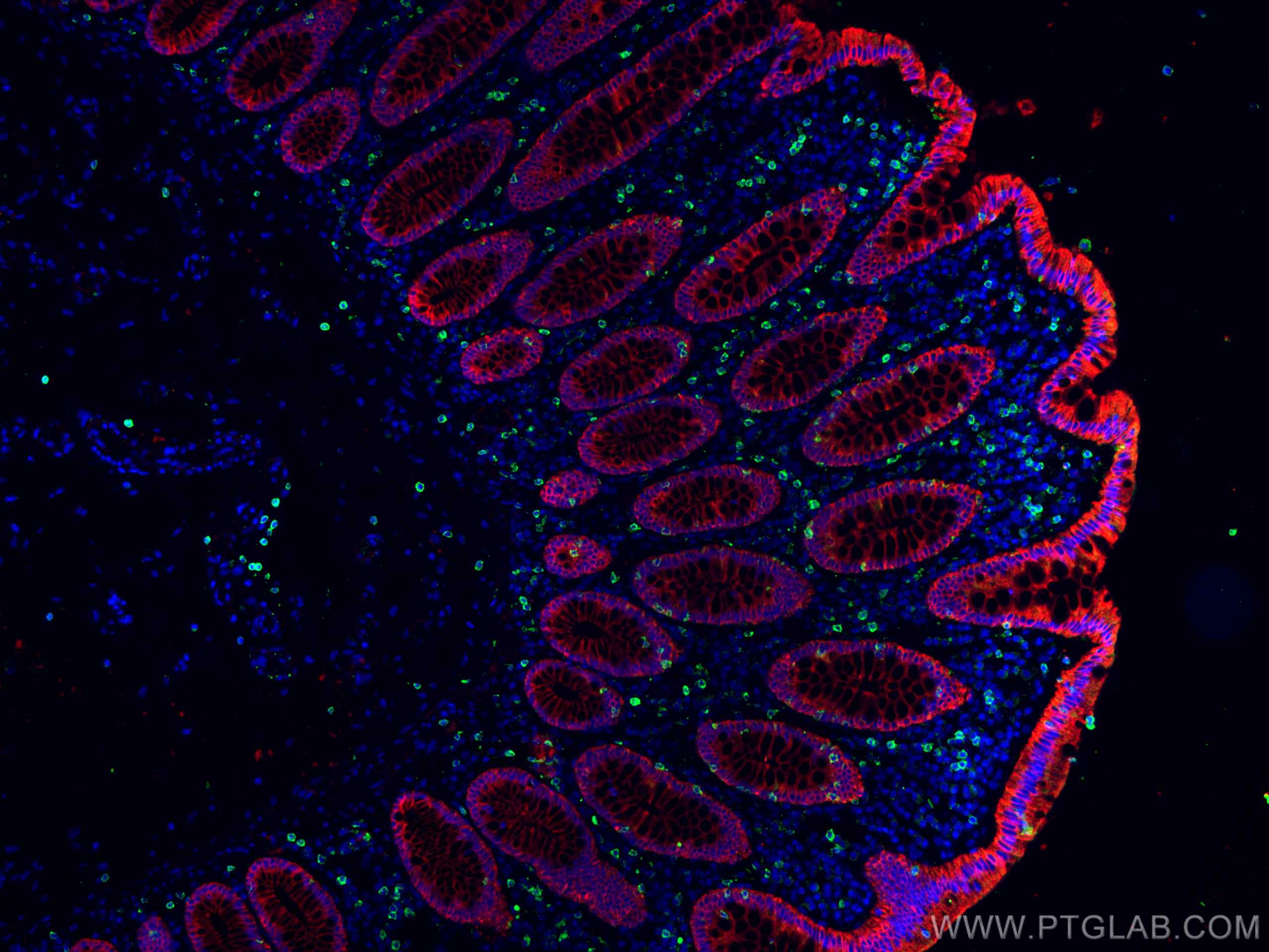 Immunofluorescence (IF) / fluorescent staining of human colon cancer tissue using pan-keratin Polyclonal antibody (26411-1-AP)