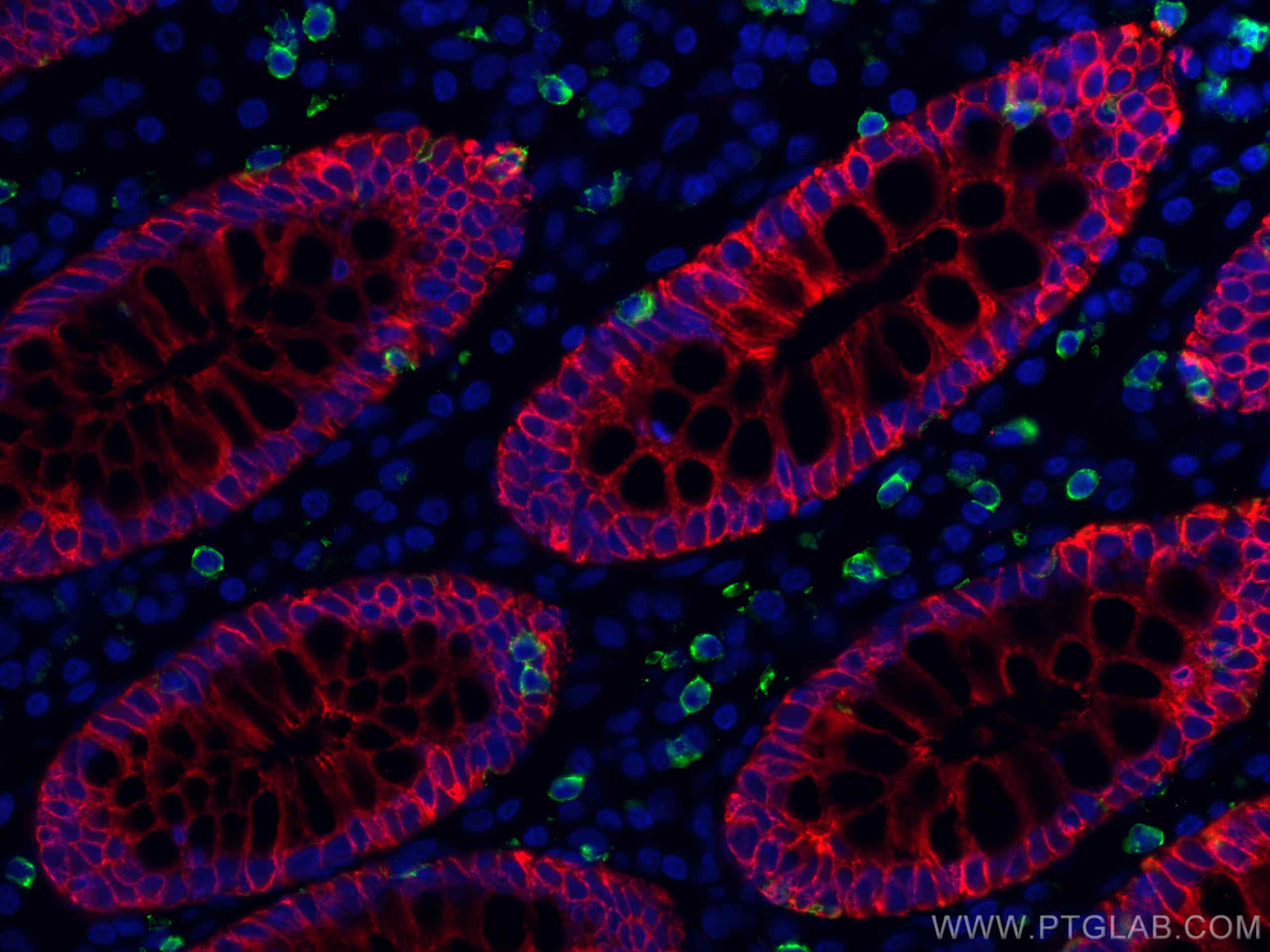 Immunofluorescence (IF) / fluorescent staining of human colon cancer tissue using pan-keratin Polyclonal antibody (26411-1-AP)