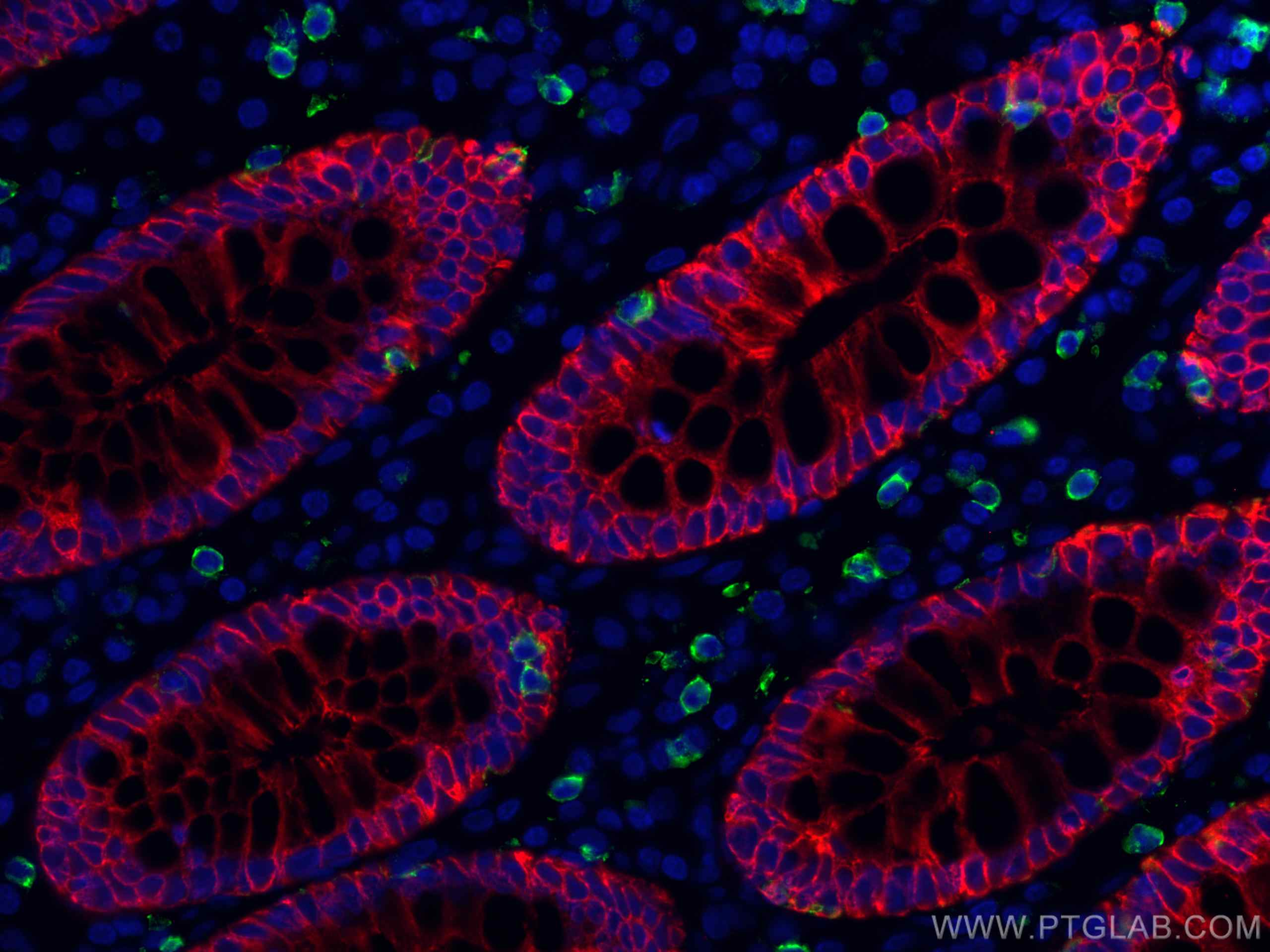 IF Staining of human colon cancer using 26411-1-AP