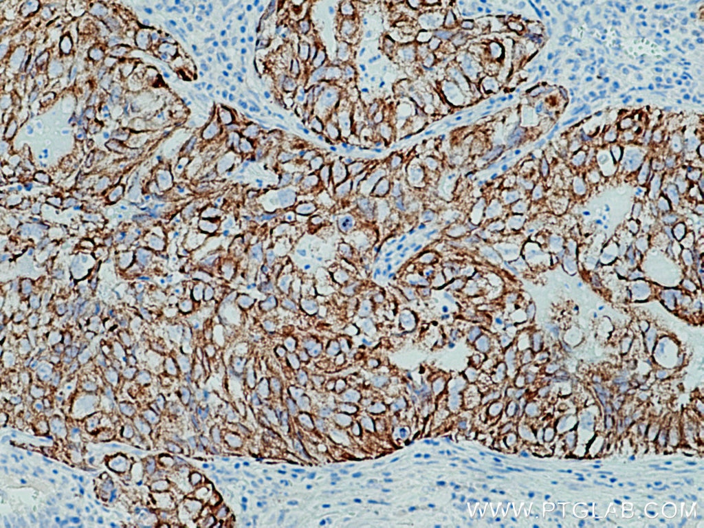 IHC staining of human lung cancer using 26411-1-AP