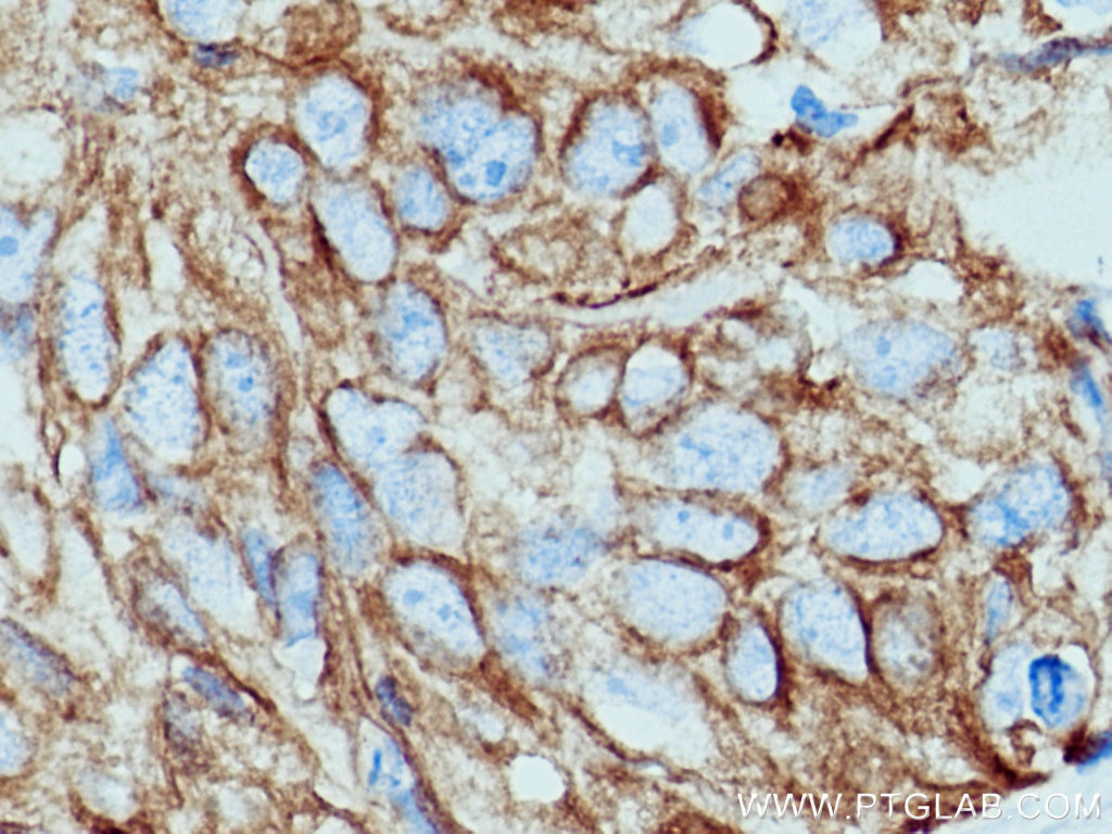 Immunohistochemistry (IHC) staining of human lung cancer tissue using pan-keratin Polyclonal antibody (26411-1-AP)