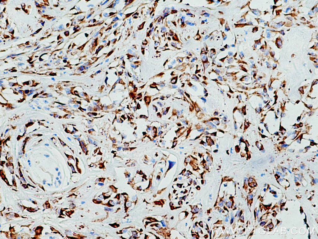 IHC staining of human renal cell carcinoma using 26411-1-AP