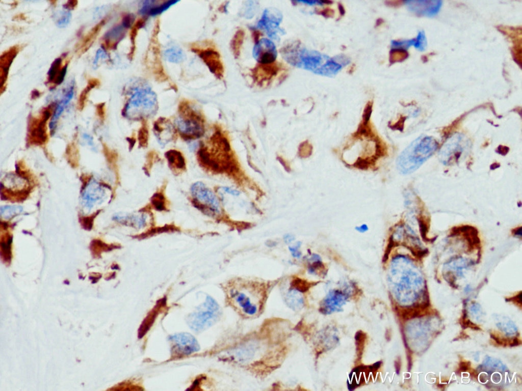 Immunohistochemistry (IHC) staining of human renal cell carcinoma tissue using pan-keratin Polyclonal antibody (26411-1-AP)