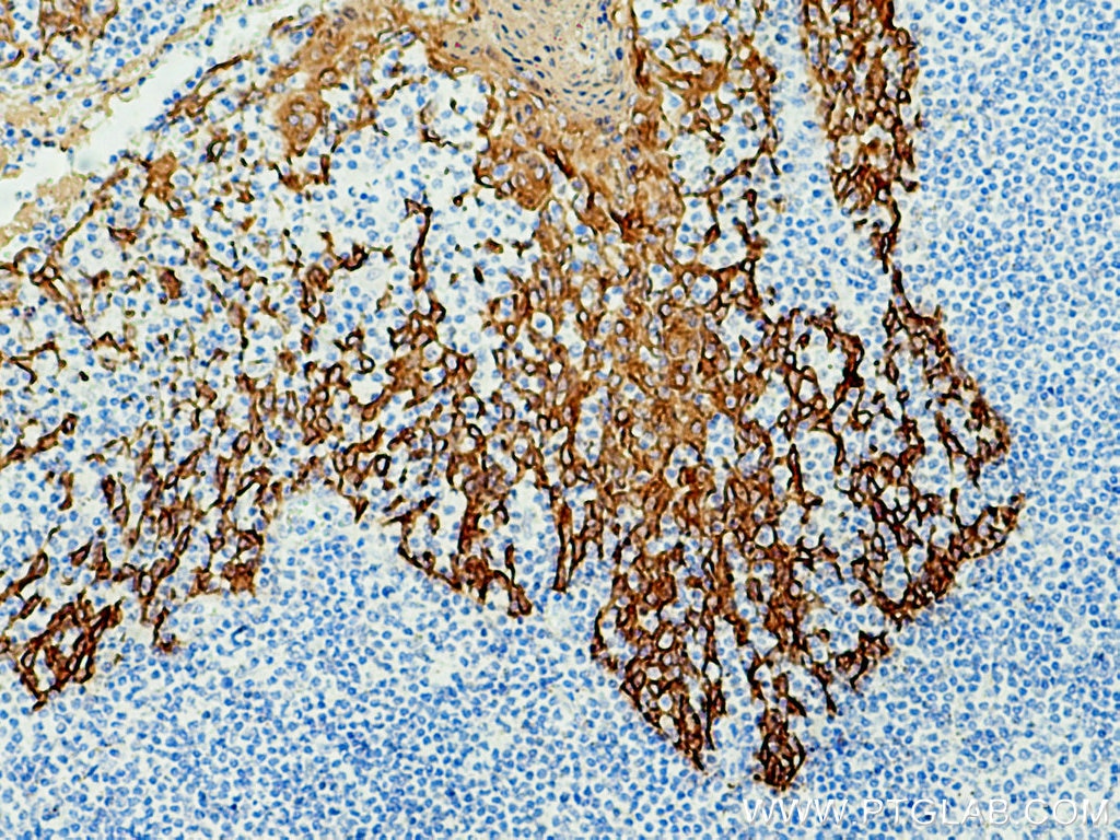 Immunohistochemistry (IHC) staining of human tonsillitis tissue using pan-keratin Polyclonal antibody (26411-1-AP)