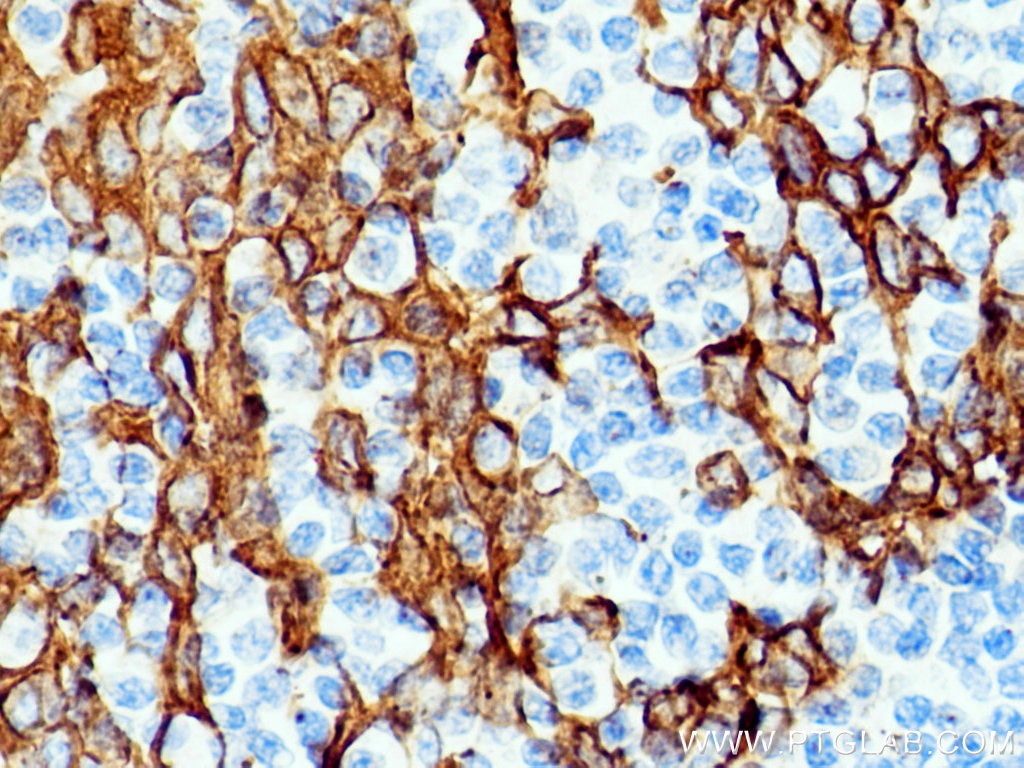 Immunohistochemistry (IHC) staining of human tonsillitis tissue using pan-keratin Polyclonal antibody (26411-1-AP)
