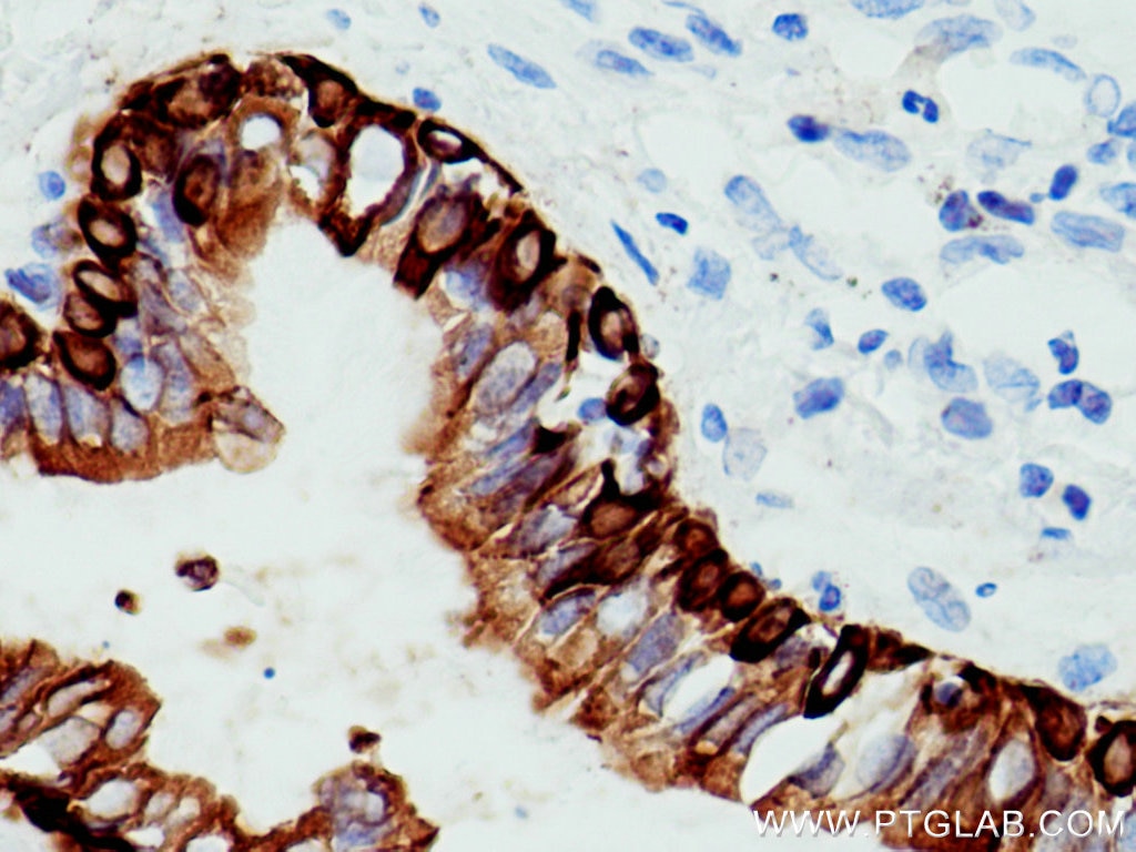 Immunohistochemistry (IHC) staining of human lung cancer tissue using pan-keratin Polyclonal antibody (26411-1-AP)