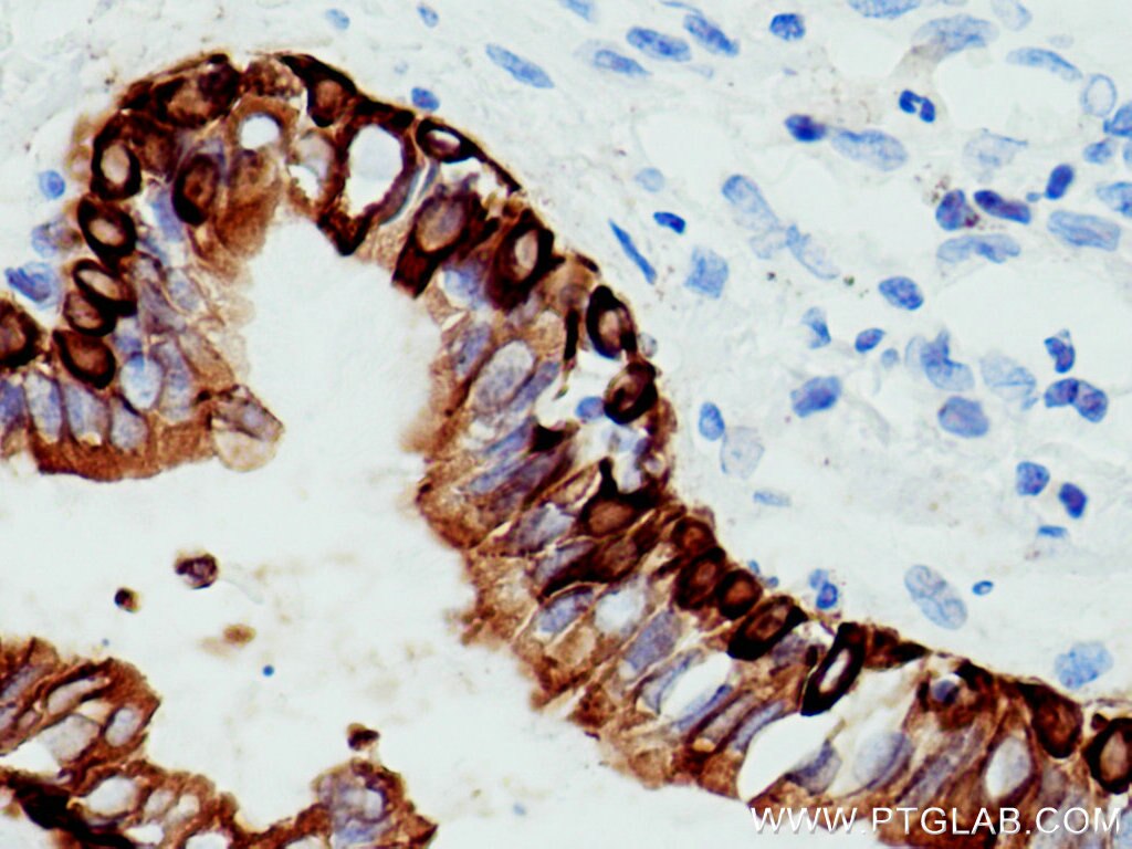 IHC staining of human lung cancer using 26411-1-AP