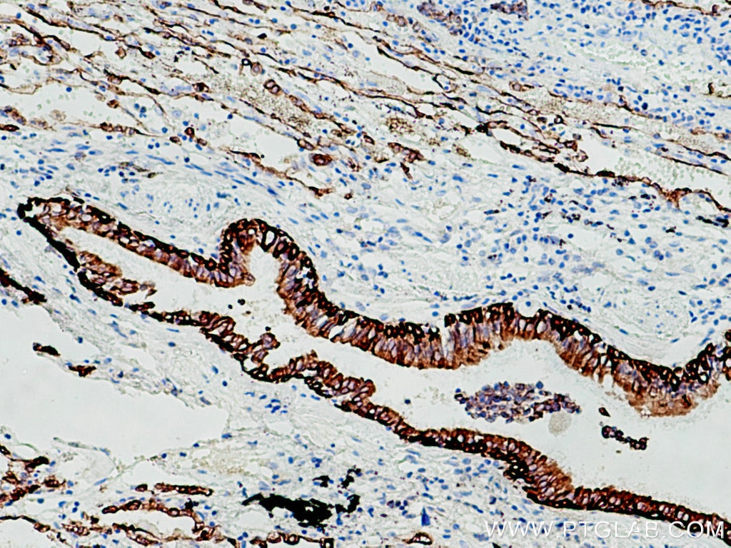 Immunohistochemistry (IHC) staining of human lung cancer tissue using pan-keratin Polyclonal antibody (26411-1-AP)