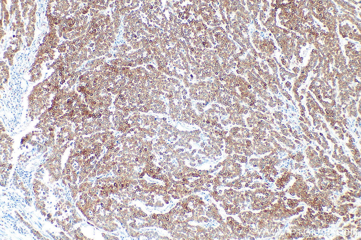 Immunohistochemistry (IHC) staining of human colon cancer tissue using Pan-Keratin Polyclonal antibody (26411-1-AP)