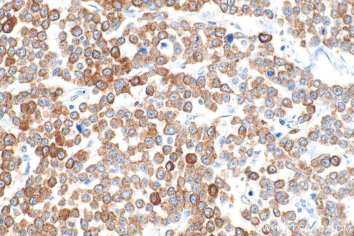 Immunohistochemistry (IHC) staining of human colon cancer tissue using Pan-Keratin Polyclonal antibody (26411-1-AP)