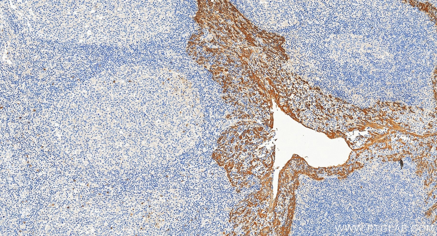 Immunohistochemistry (IHC) staining of human tonsillitis tissue using Pan-Keratin Polyclonal antibody (26411-1-AP)