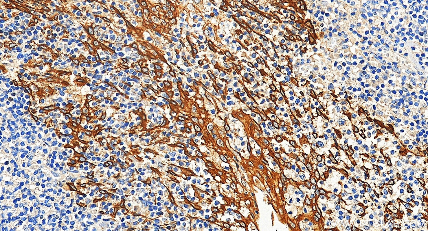 Immunohistochemistry (IHC) staining of human tonsillitis tissue using Pan-Keratin Polyclonal antibody (26411-1-AP)