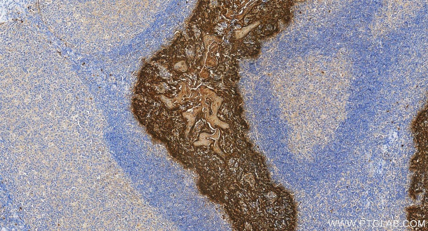 Immunohistochemistry (IHC) staining of human tonsillitis tissue using Pan-Keratin Polyclonal antibody (26411-1-AP)