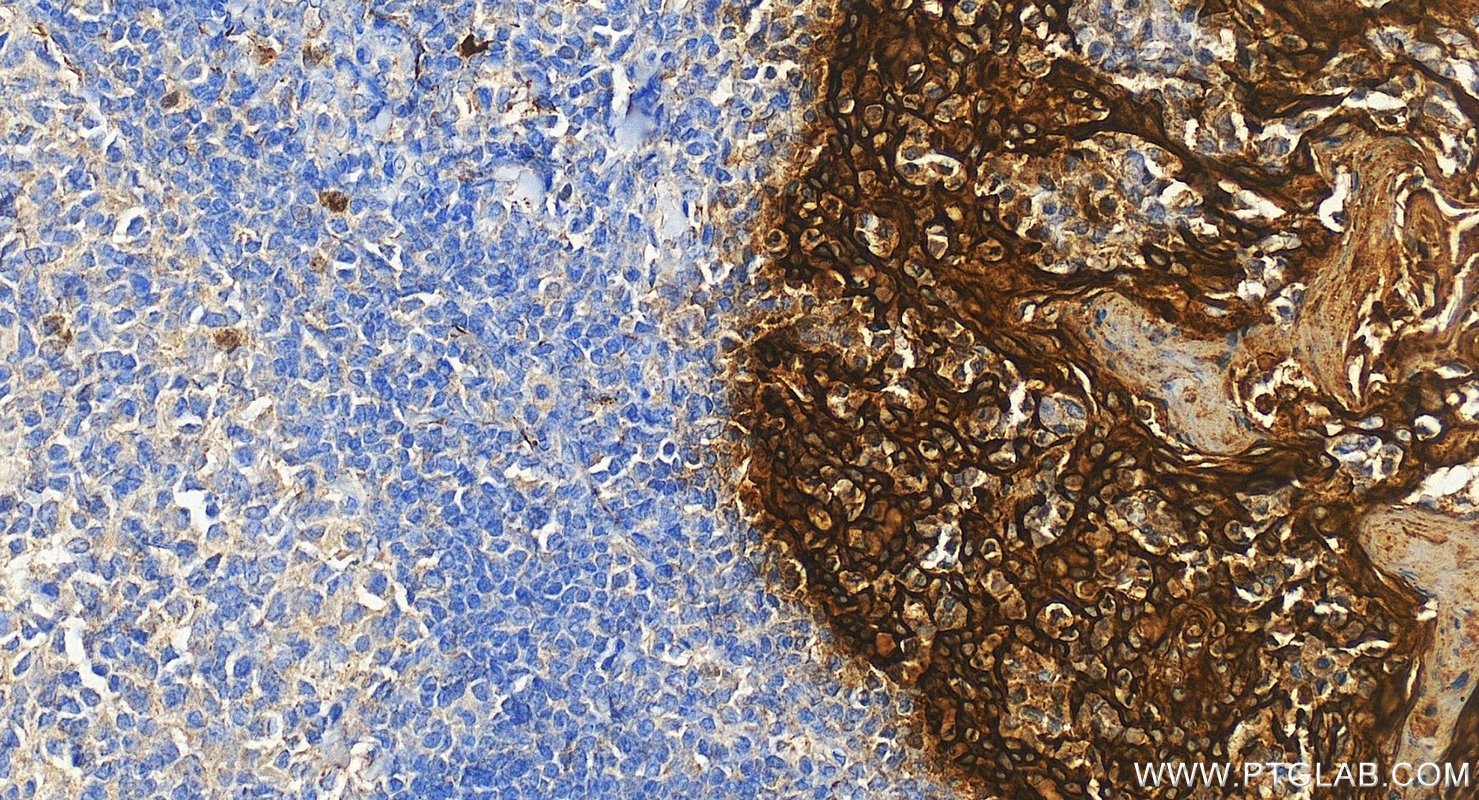 Immunohistochemistry (IHC) staining of human tonsillitis tissue using Pan-Keratin Polyclonal antibody (26411-1-AP)