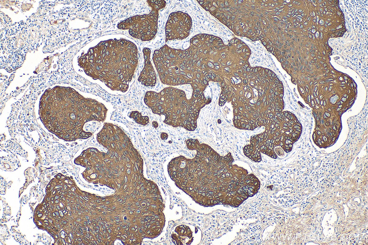 Immunohistochemical analysis of paraffin-embedded human lung squamous cell carcinoma tissue slide using 82548-3-RR (KRT5 antibody) at dilution of 1:1000 (under 10x lens). Heat mediated antigen retrieval with Tris-EDTA buffer (pH 9.0). Immunohistochemistry (IHC) staining of human lung cancer tissue using pan-keratin Recombinant antibody (82548-3-RR)