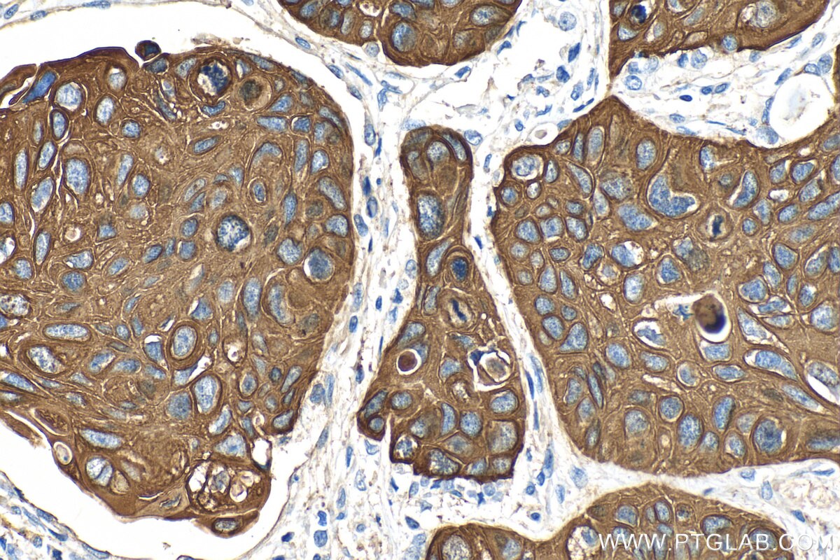 Immunohistochemical analysis of paraffin-embedded human lung squamous cell carcinoma tissue slide using 82548-3-RR (KRT5 antibody) at dilution of 1:1000 (under 40x lens). Heat mediated antigen retrieval with Tris-EDTA buffer (pH 9.0). Immunohistochemistry (IHC) staining of human lung cancer tissue using pan-keratin Recombinant antibody (82548-3-RR)