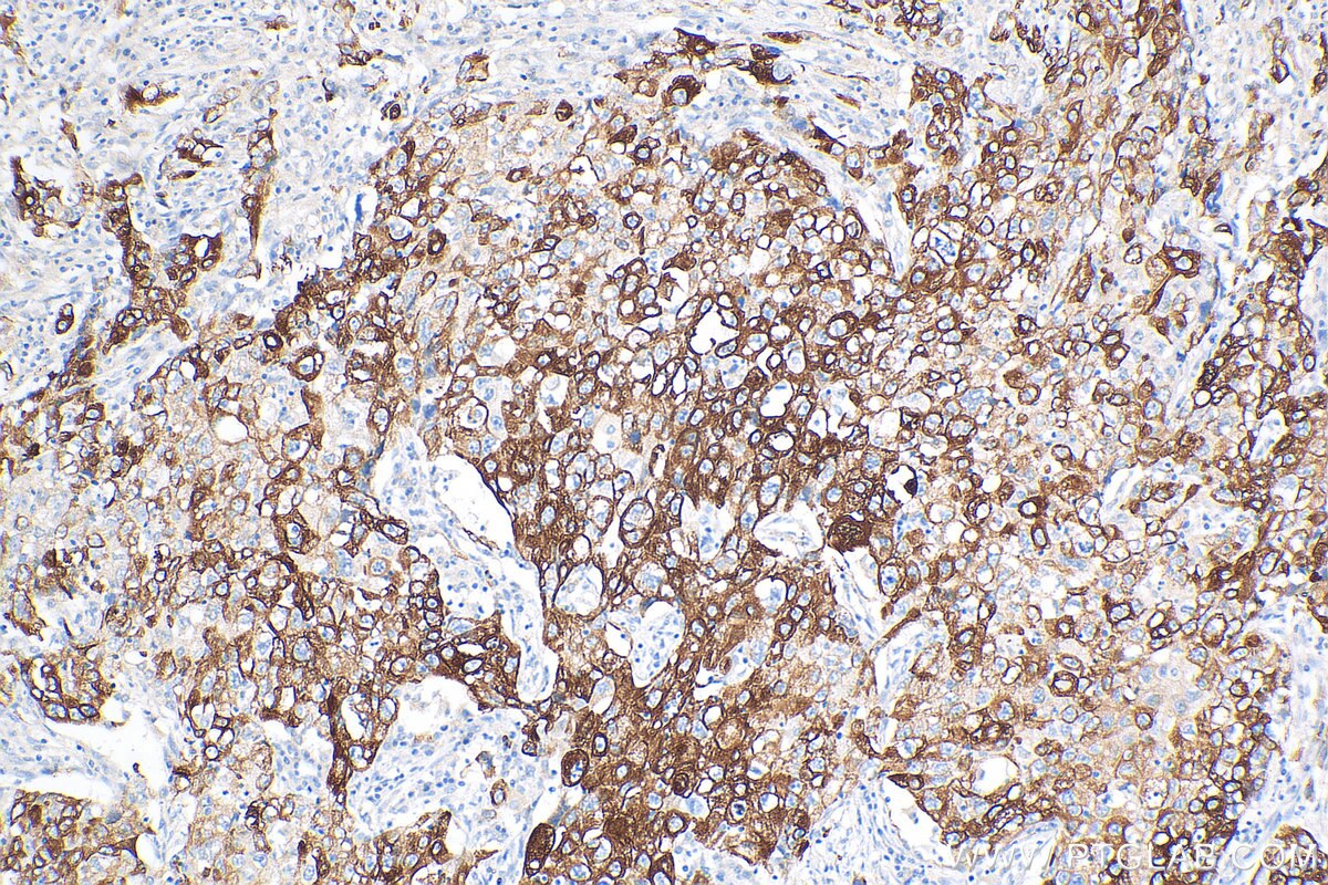 Immunohistochemical analysis of paraffin-embedded human lung adenocarcinoma tissue slide using 82548-3-RR (KRT5 antibody) at dilution of 1:1000 (under 10x lens). Heat mediated antigen retrieval with Tris-EDTA buffer (pH 9.0). Immunohistochemistry (IHC) staining of human lung cancer tissue using pan-keratin Recombinant antibody (82548-3-RR)