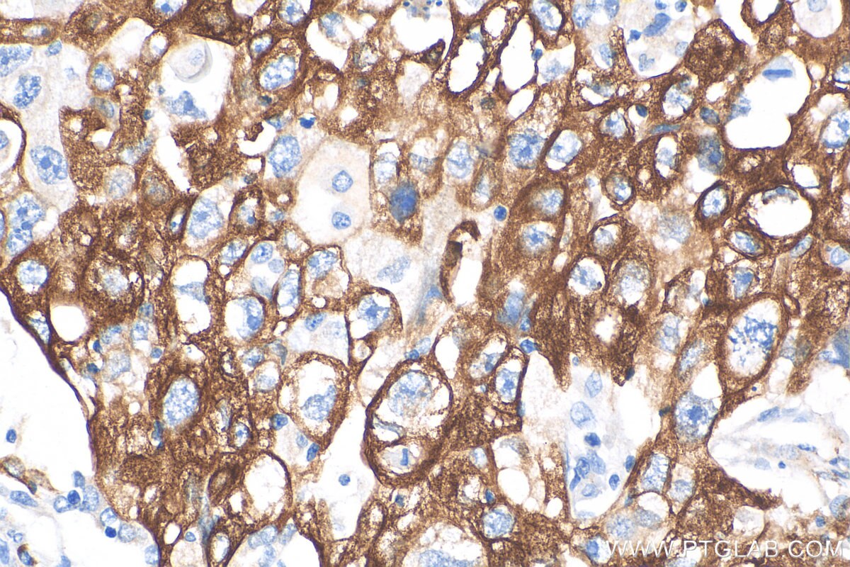Immunohistochemical analysis of paraffin-embedded human lung adenocarcinoma tissue slide using 82548-3-RR (KRT5 antibody) at dilution of 1:1000 (under 40x lens). Heat mediated antigen retrieval with Tris-EDTA buffer (pH 9.0). Immunohistochemistry (IHC) staining of human lung cancer tissue using pan-keratin Recombinant antibody (82548-3-RR)