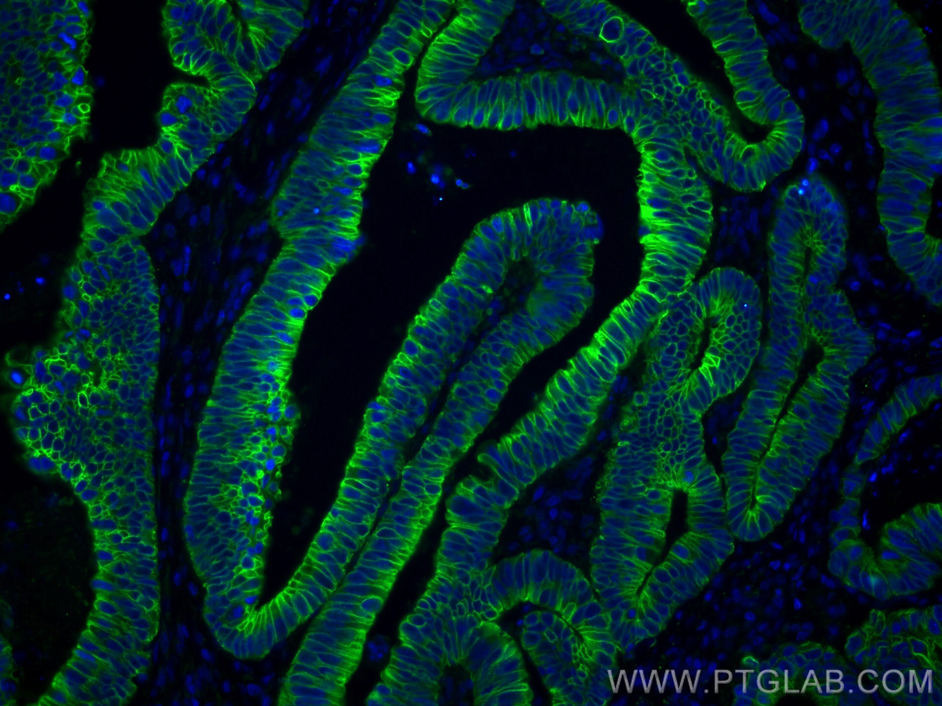 Immunofluorescence (IF) / fluorescent staining of human colon cancer tissue using CoraLite® Plus 488-conjugated pan-keratin Polyclon (CL488-26411)