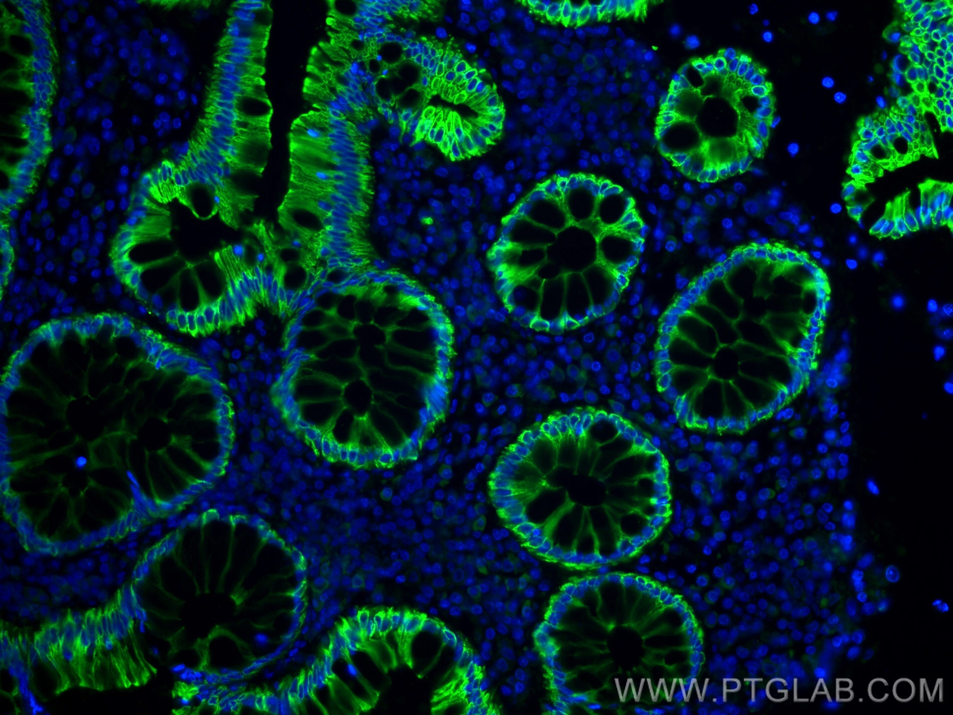 Immunofluorescence (IF) / fluorescent staining of human colon cancer tissue using CoraLite® Plus 488-conjugated pan-keratin Polyclon (CL488-26411)