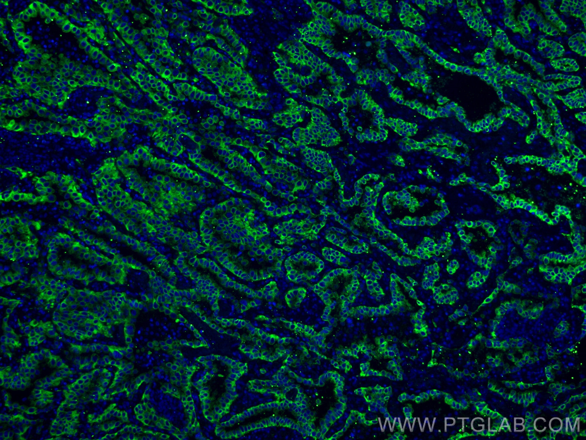 Immunofluorescence (IF) / fluorescent staining of human lung cancer tissue using CoraLite® Plus 488-conjugated pan-keratin Polyclon (CL488-26411)