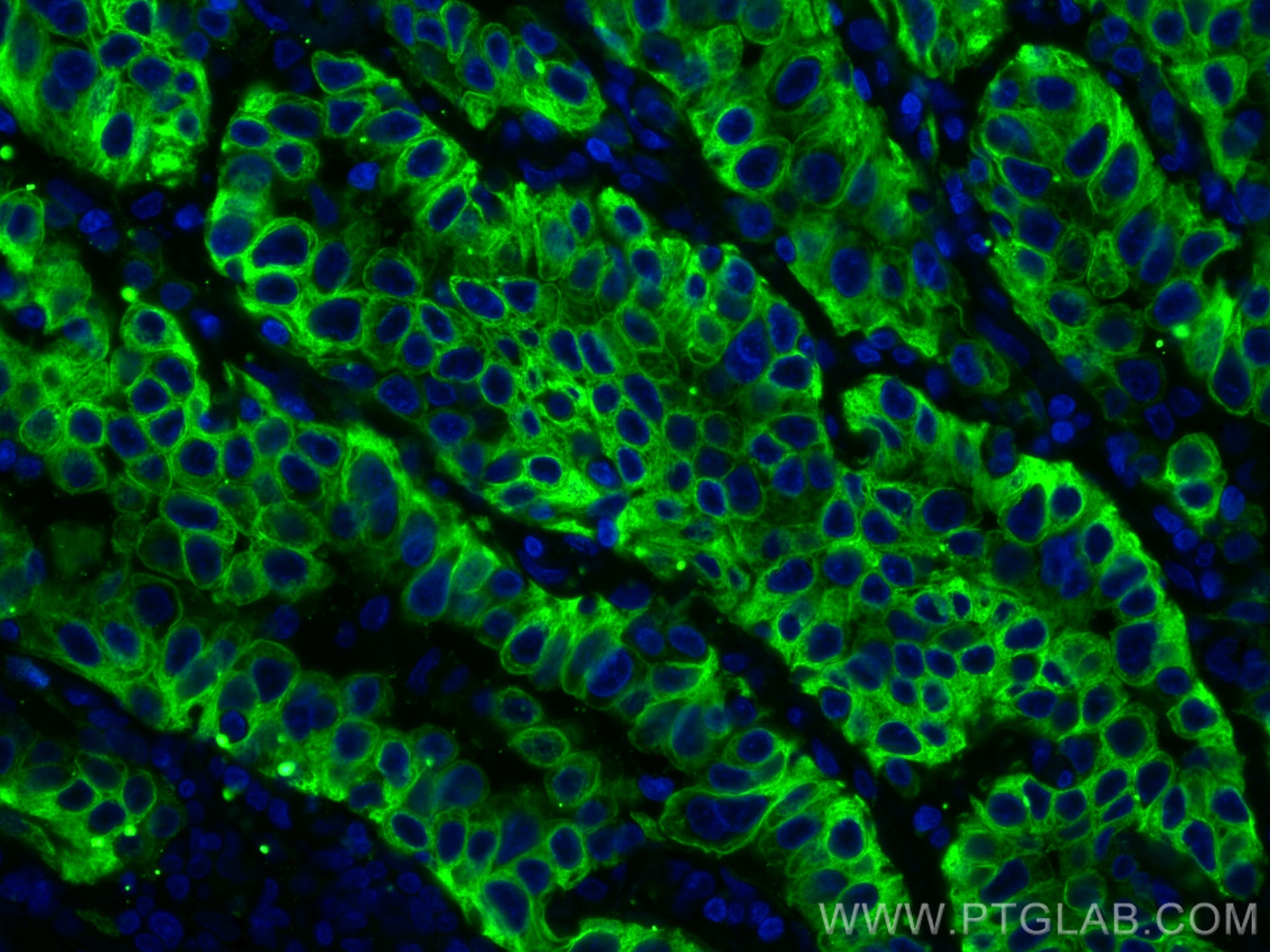 IF Staining of human lung cancer using CL488-26411