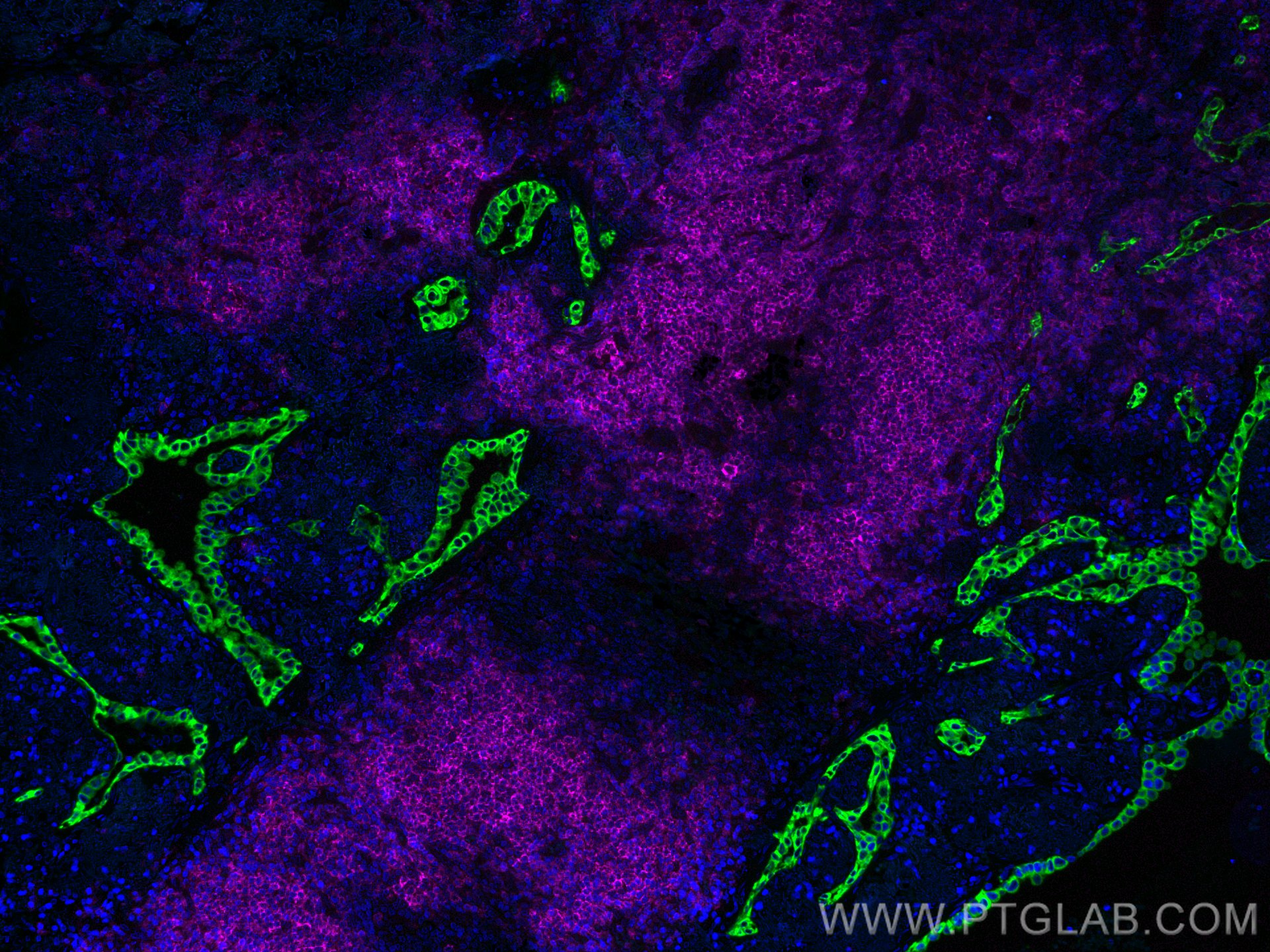 Immunofluorescence (IF) / fluorescent staining of human lung cancer tissue using CoraLite® Plus 488-conjugated pan-keratin Polyclon (CL488-26411)