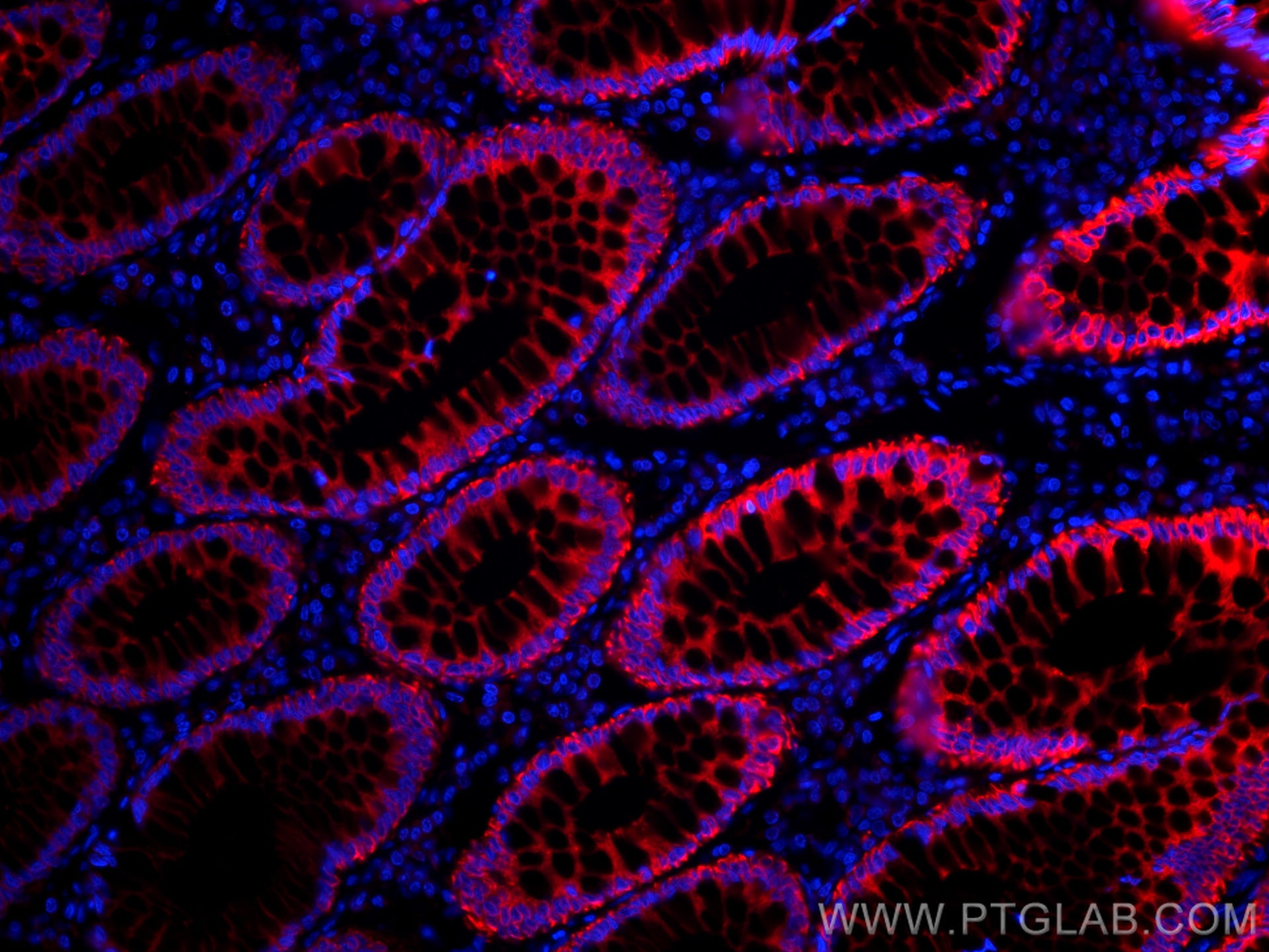 Immunofluorescence (IF) / fluorescent staining of human colon cancer tissue using CoraLite®555-conjugated pan-keratin Polyclonal ant (CL555-26411)