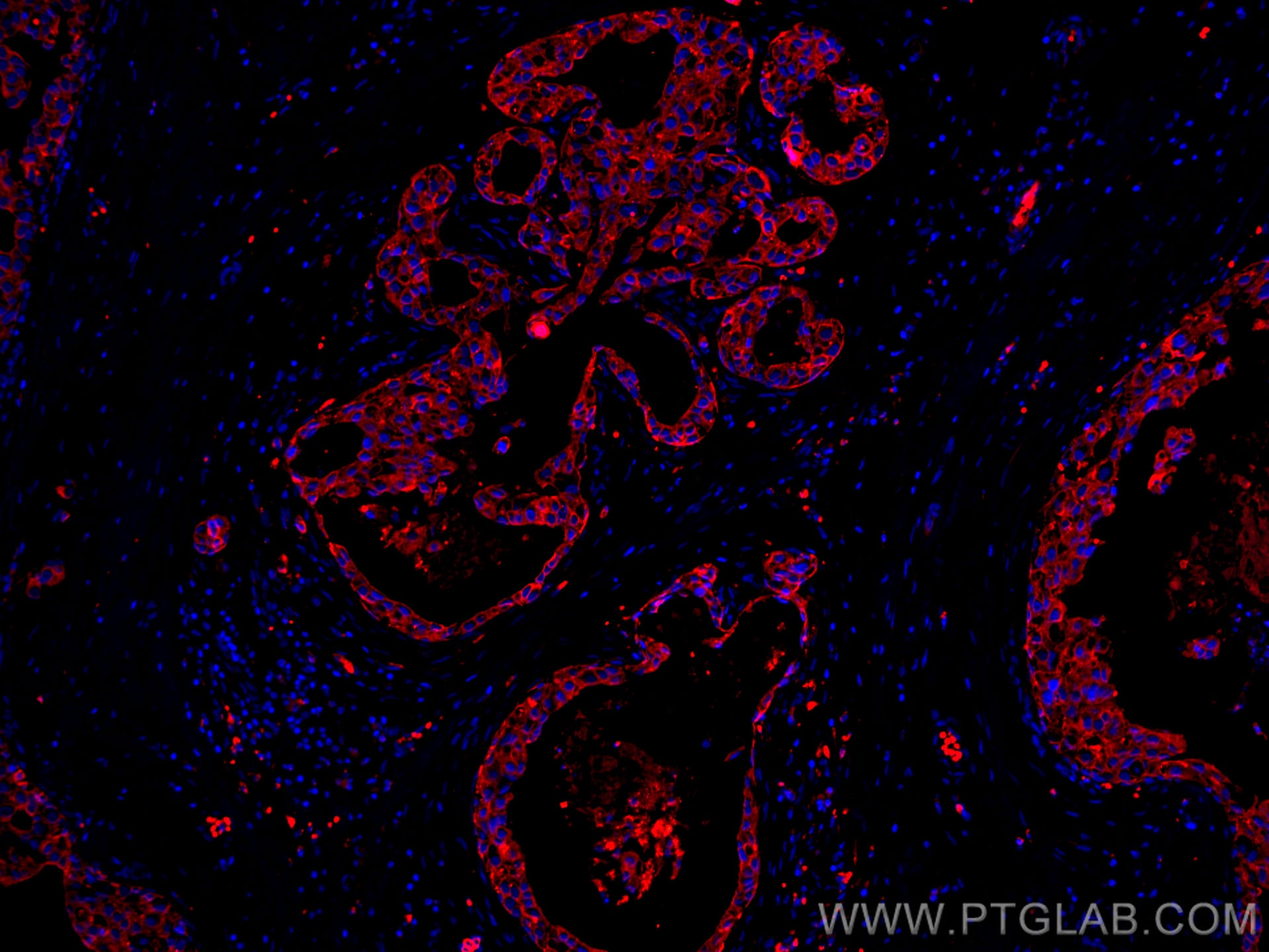 Immunofluorescence (IF) / fluorescent staining of human breast cancer tissue using CoraLite®555-conjugated pan-keratin Polyclonal ant (CL555-26411)