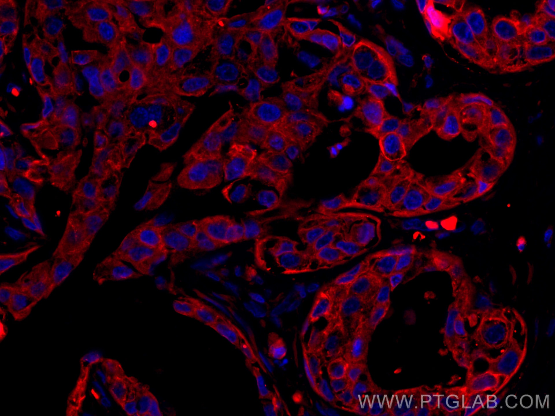 Immunofluorescence (IF) / fluorescent staining of human breast cancer tissue using CoraLite®555-conjugated pan-keratin Polyclonal ant (CL555-26411)