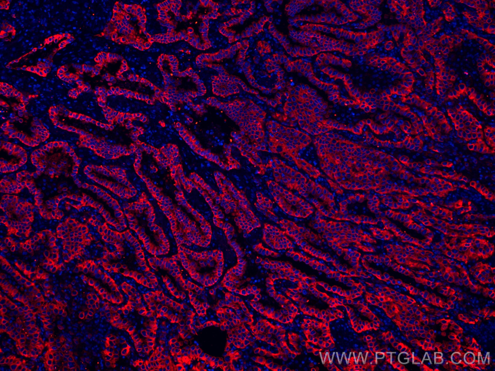 Immunofluorescence (IF) / fluorescent staining of human lung cancer tissue using CoraLite®555-conjugated pan-keratin Polyclonal ant (CL555-26411)