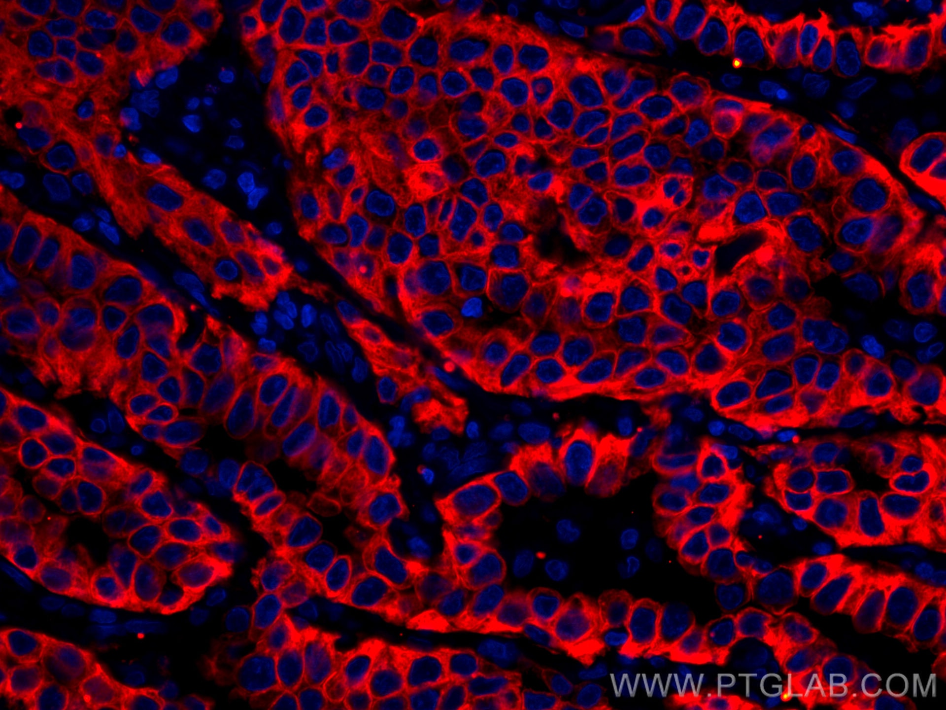 Immunofluorescence (IF) / fluorescent staining of human lung cancer tissue using CoraLite®555-conjugated pan-keratin Polyclonal ant (CL555-26411)