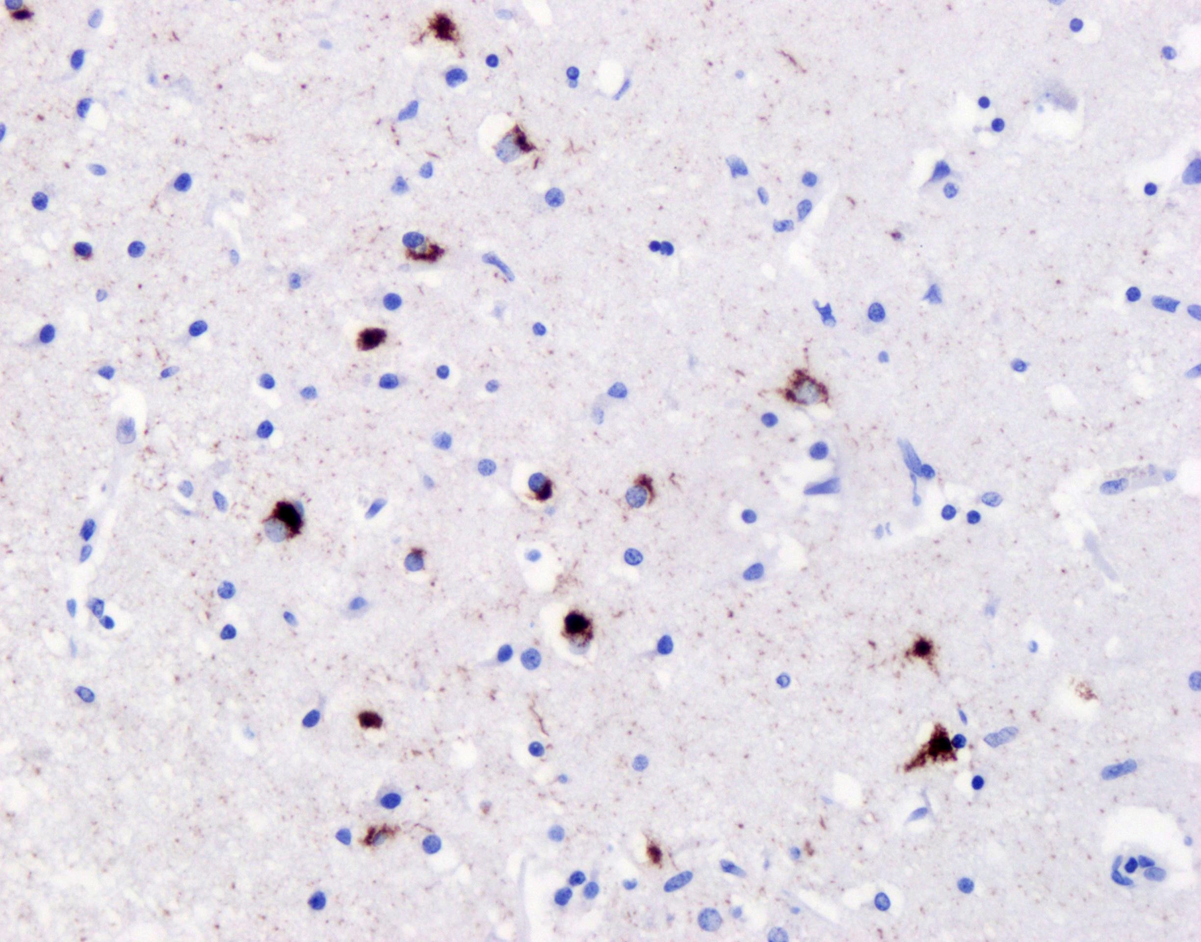 Immunohistochemistry (IHC) staining of frontal cortex of FTLD-TDP type B case using Phospho-TDP43 (Ser409/410) Recombinant antibody (80007-1-RR)