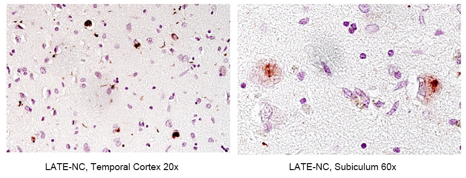 Immunohistochemistry (IHC) staining of human brain tissue using Phospho-TDP43 (Ser409/410) Recombinant antibody (80007-1-RR)