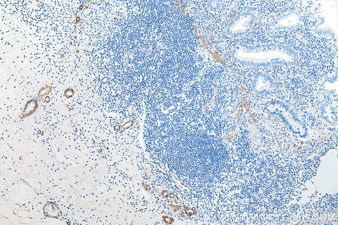 Immunohistochemistry (IHC) staining of human appendicitis tissue using smooth muscle actin specific Monoclonal antibody (67735-1-Ig)