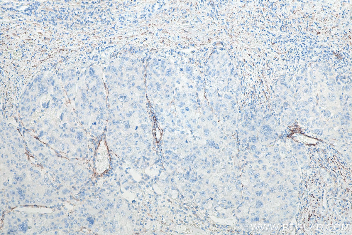 Immunohistochemistry (IHC) staining of human liver cancer tissue using smooth muscle actin specific Monoclonal antibody (67735-1-Ig)