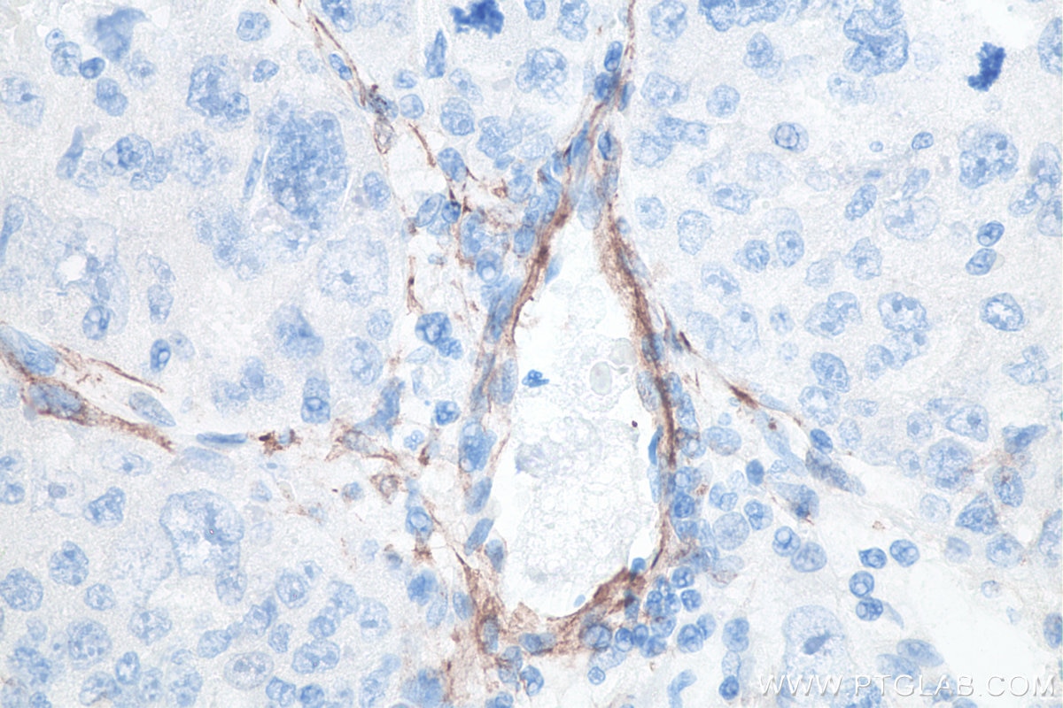 Immunohistochemistry (IHC) staining of human liver cancer tissue using smooth muscle actin specific Monoclonal antibody (67735-1-Ig)