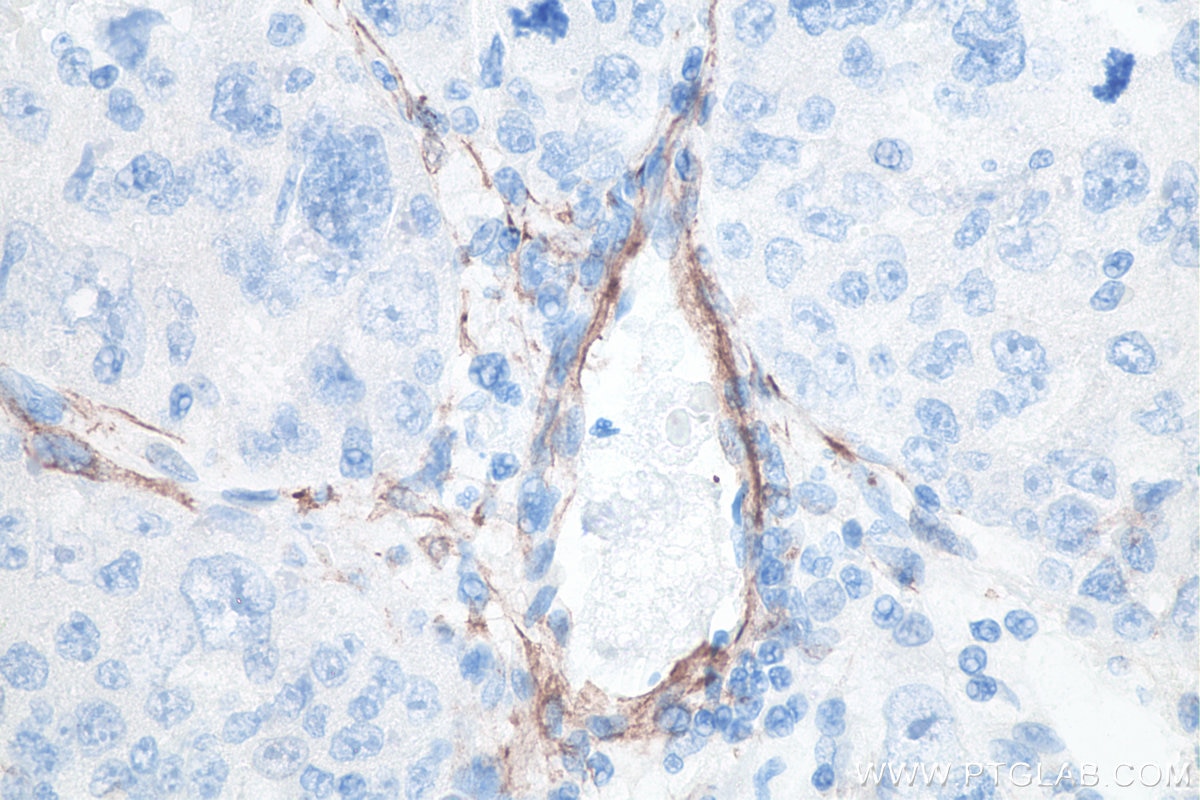 IHC staining of human liver cancer using 67735-1-Ig