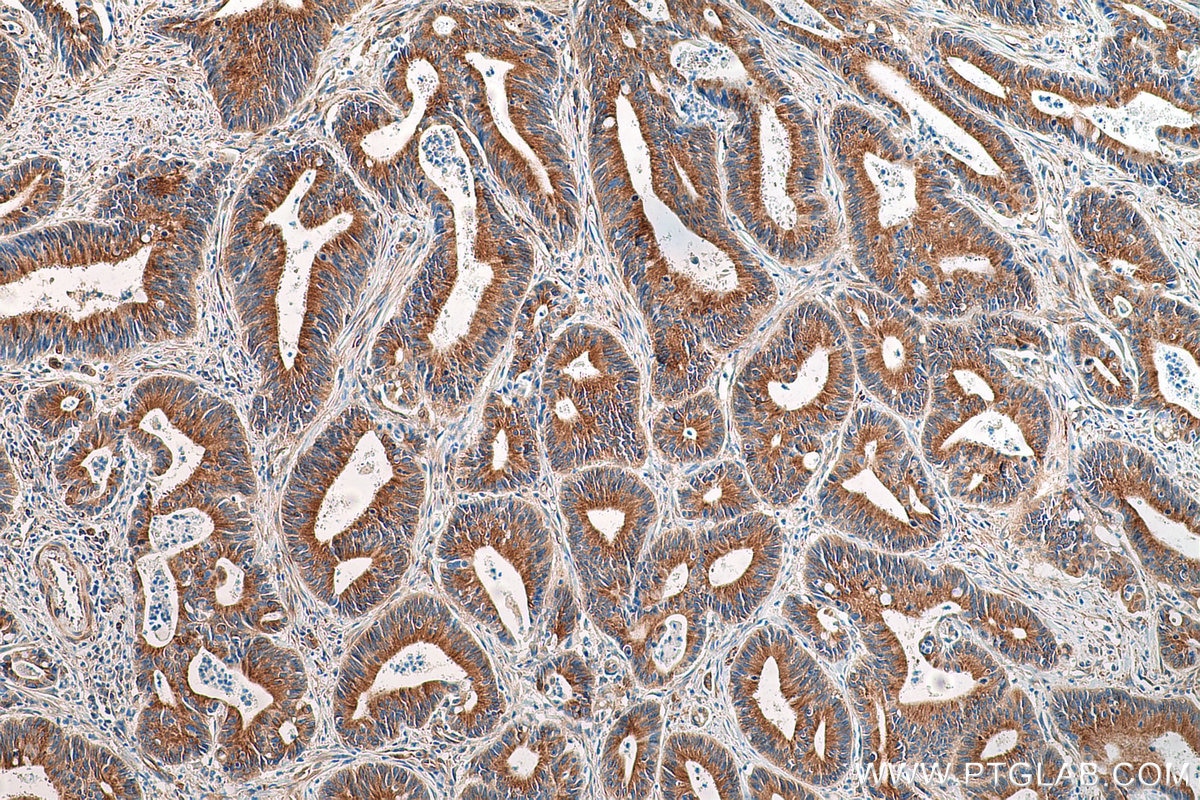 Immunohistochemistry (IHC) staining of human colon cancer tissue using Alpha Tubulin Monoclonal antibody (66031-1-Ig)