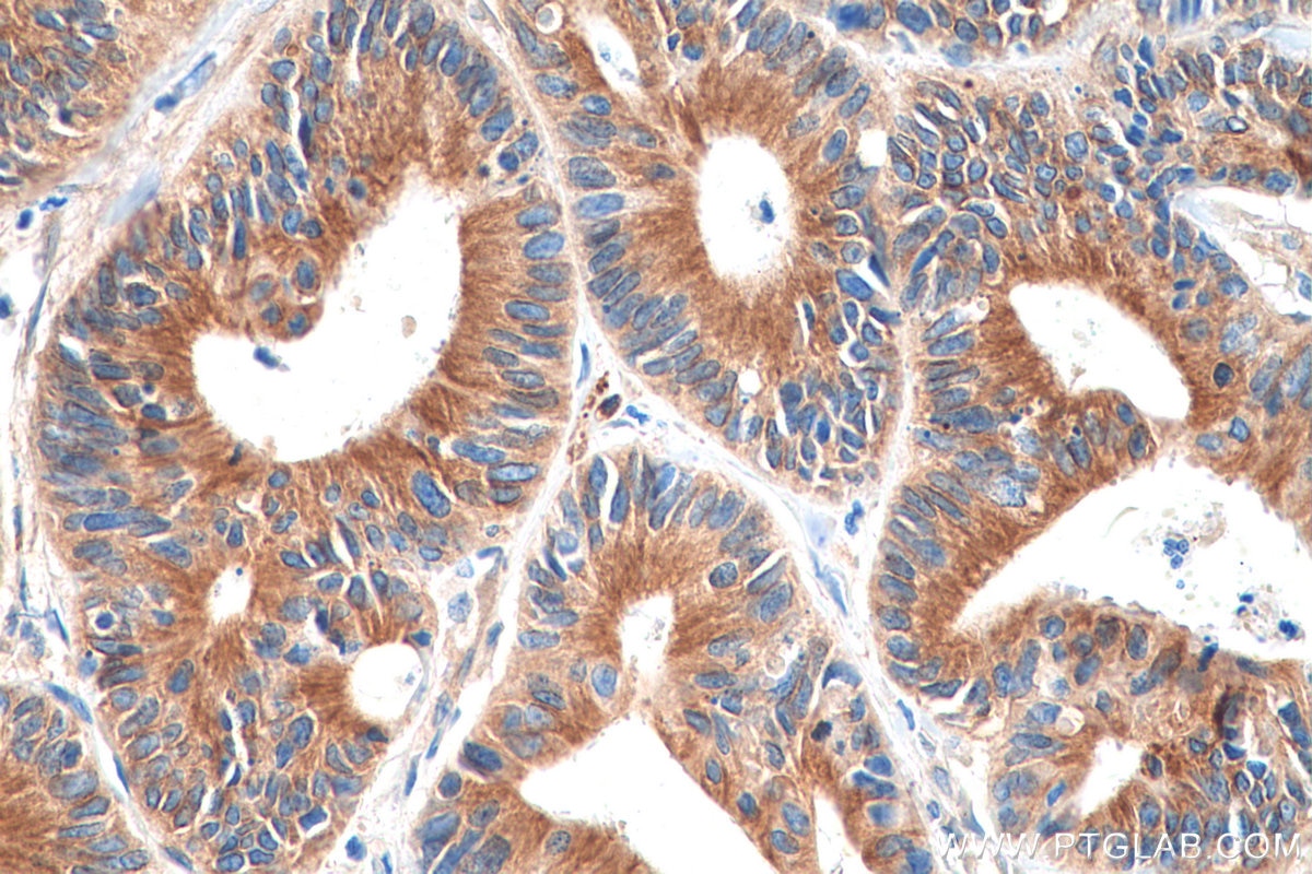 IHC staining of human colon cancer using 66031-1-Ig