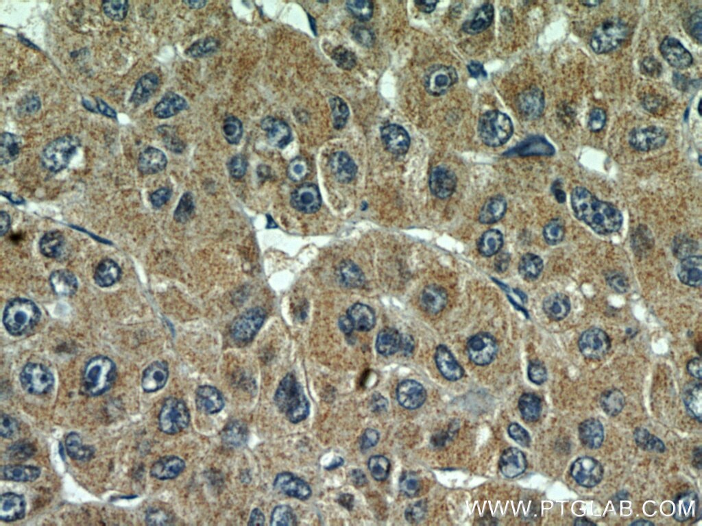 IHC staining of human liver cancer using 66031-1-Ig