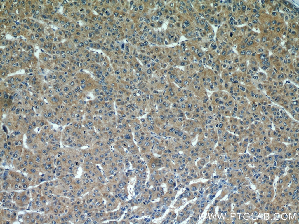 Immunohistochemistry (IHC) staining of human liver cancer tissue using Alpha Tubulin Monoclonal antibody (66031-1-Ig)