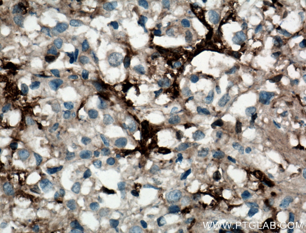 Immunohistochemistry (IHC) staining of human breast cancer tissue using Gamma Tubulin Monoclonal antibody (66320-1-Ig)