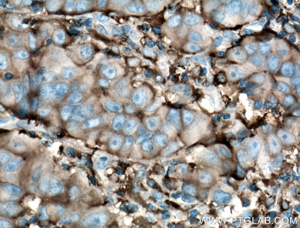 Immunohistochemistry (IHC) staining of human prostate cancer tissue using Gamma Tubulin Monoclonal antibody (66320-1-Ig)