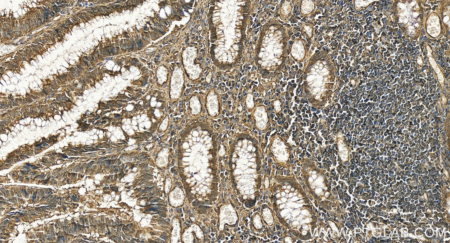 Immunohistochemistry (IHC) staining of human colon cancer tissue using uPAR/CD87 Recombinant antibody (82953-1-RR)