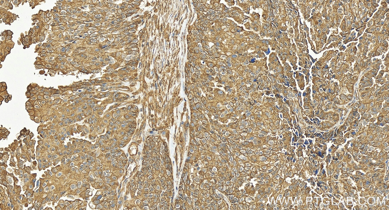 Immunohistochemistry (IHC) staining of human ovary cancer tissue using uPAR/CD87 Recombinant antibody (82953-1-RR)